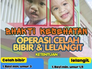 Sambut Hari Bhayangkara ke-80, Polda Jateng Gelar Operasi Gratis Celah Bibir dan Lelangit di RS Bhayangkara Semarang*